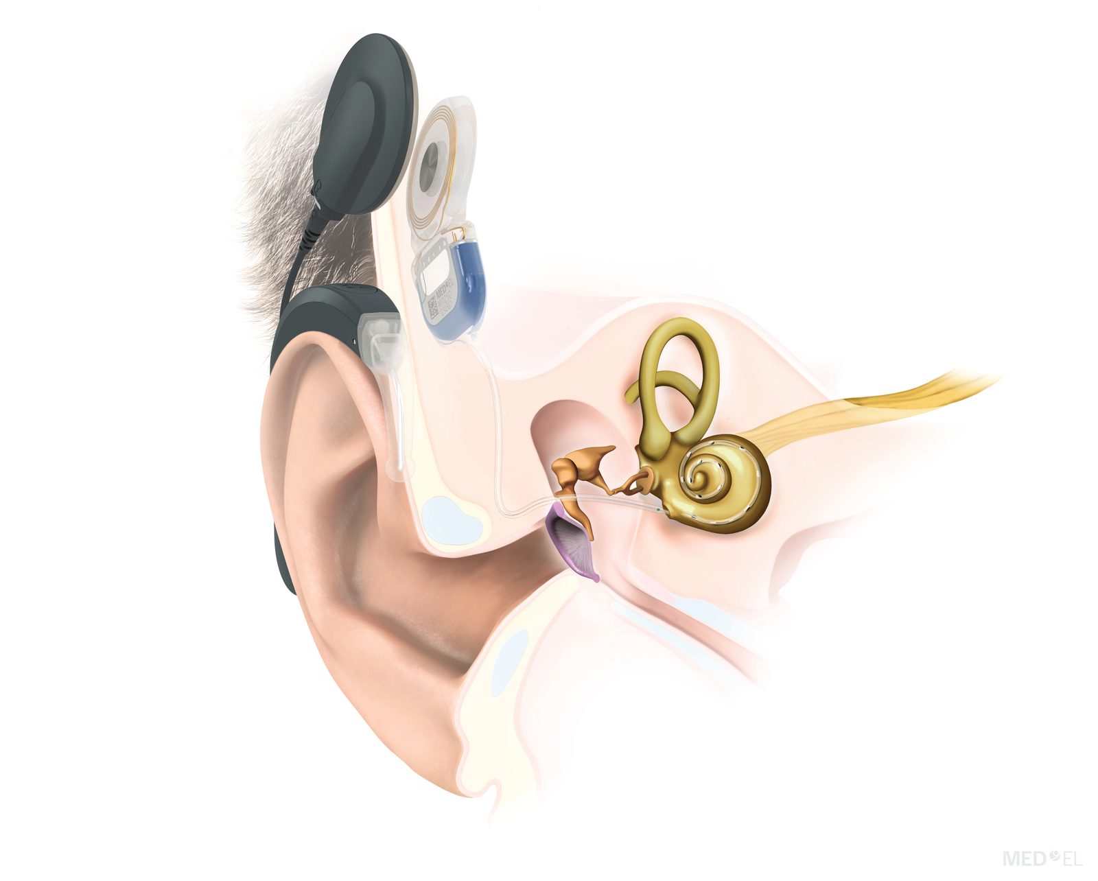 Anatomische Darstellung eines Cochlea-Implantats am Ohr